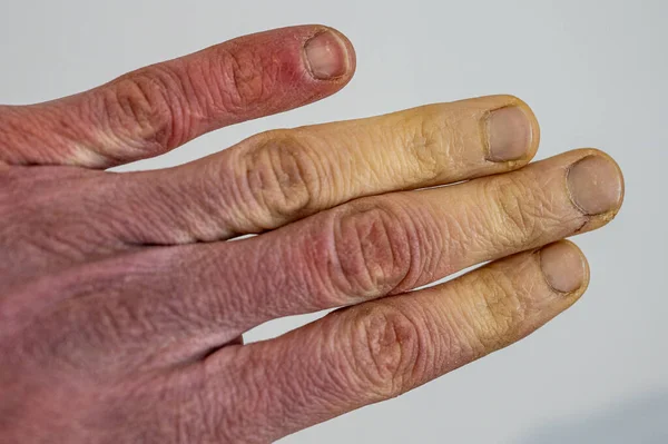 Ένα Ψυχρό Αρσενικό Χέρι Σύνδρομο Raynaud Φαινόμενο Του Raynaud Νόσο — Φωτογραφία Αρχείου