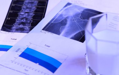 Osteoporoz erken Stadyumu tıbbi mavi renkli