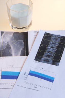 Close-up photograph of DXA osteoporosis diagnosis clipart