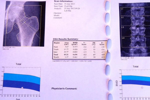 Διάγνωση της οστεοπόρωσης — Φωτογραφία Αρχείου