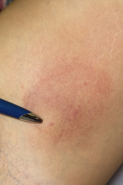 Allergic reaction after insect bite,acute state-closeup — Stock Photo, Image