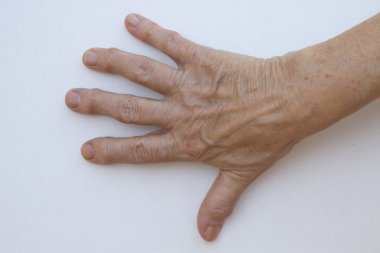 artrit ile el closeup