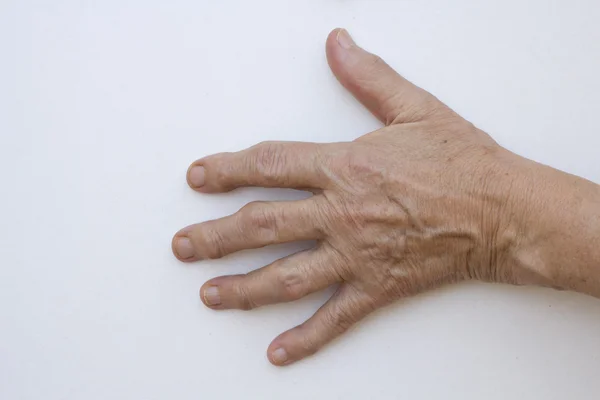Primer plano de la mano con artritis — Foto de Stock