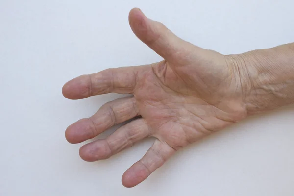 Close-up van de hand met artritis — Stockfoto