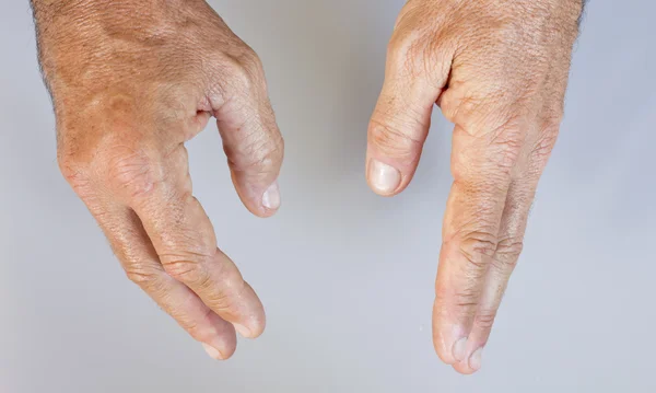 Mão inchada e mão masculina saudável — Fotografia de Stock