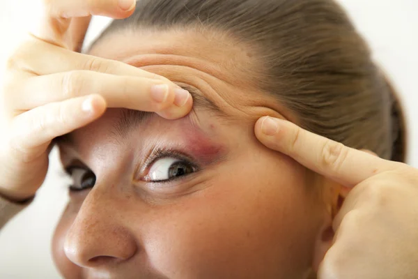 Mujer joven con el ojo magullado — Foto de Stock