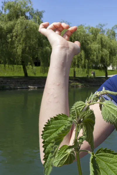 Réaction allergique à l'ortie piquante — Photo