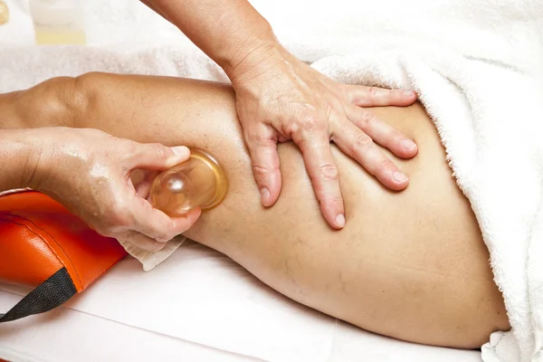 Anti-Cellulite-Massage mit Ventuza-Vakuum-Abzieher Stockbild