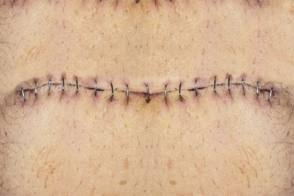 Stitches on belly — Stock Photo, Image