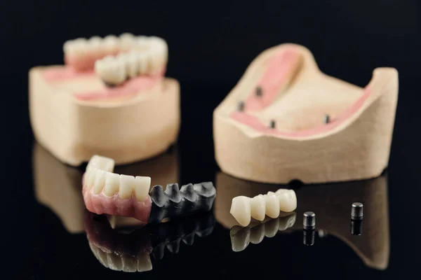 Composition of dental crowns and orthopedic components on a black background. Zirconia Full Anatomy