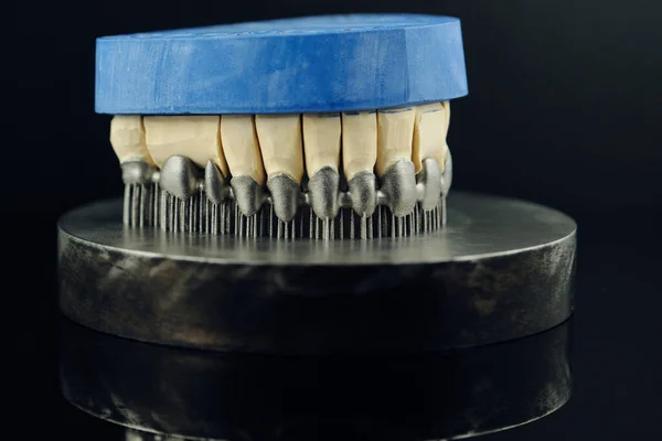 Tooth Dental Crowns Created Printer Metal Gypsum Model Printed Metal — Stock Photo, Image