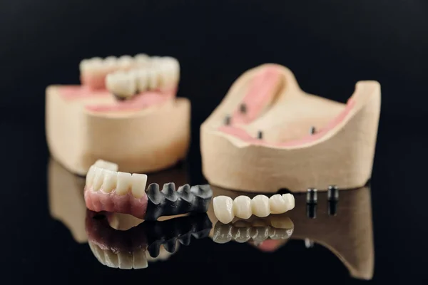 Composition of dental crowns and orthopedic components on a black background. Zirconia Full Anatomy