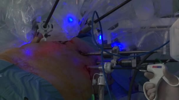 Surgery Operation Machine — Vídeo de stock