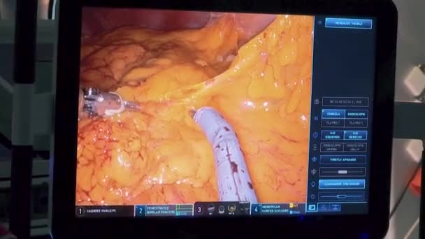 Monitoring Arms Surgery Machine Operating Adipose Tissue Human Body — Videoclip de stoc
