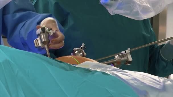 Dispositivos Utilização Cirúrgica Médica Durante Operação — Vídeo de Stock