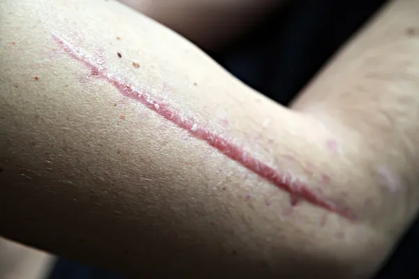 Scar on human skin — Stock Photo, Image