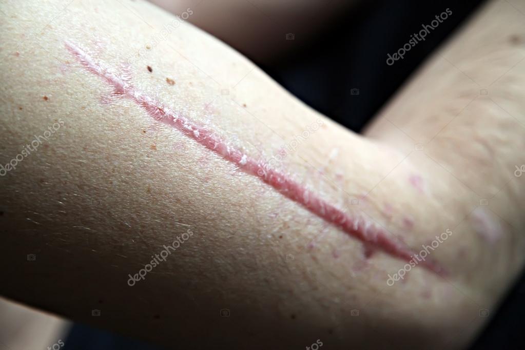 scar on human skin