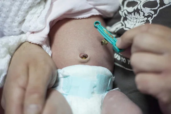 De gedroogde stomp van een navelstreng in een pasgeboren baby navel. het snoer zal uiteindelijk af vallen. de huid op deze baby's buik is ook vergieten, een typische fase van pasgeboren ontwikkeling. Stockfoto