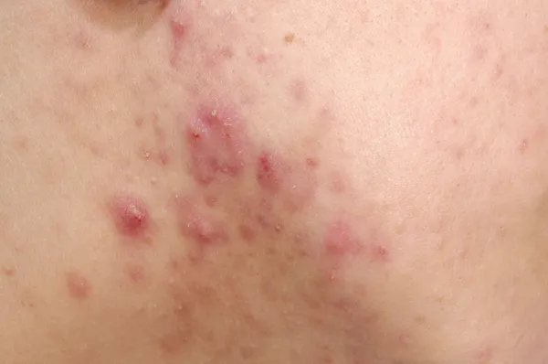 Problemas de acne — Fotografia de Stock