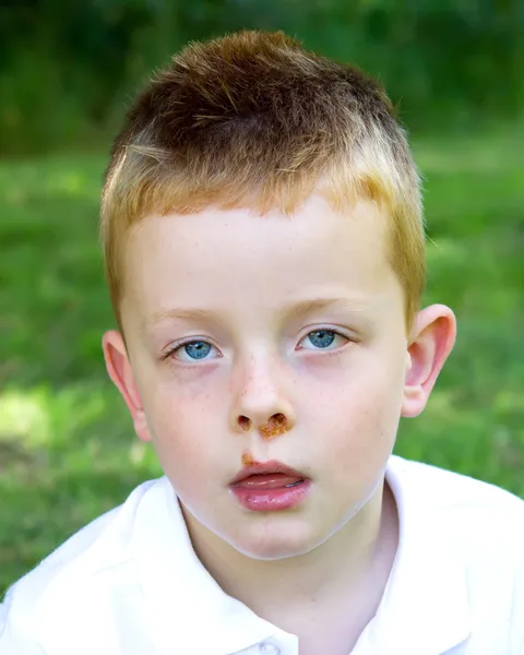 Young boy suffering from skin disease impetigo — Stock Photo, Image