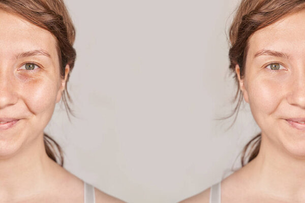 Довольно взрослая девушка. До и после портрета. Противоморщинки здоровой терапии. Черный круг под глазами. Коллагеновый крем. Косметологическое омоложение. Модель красоты. Результат процедуры
.