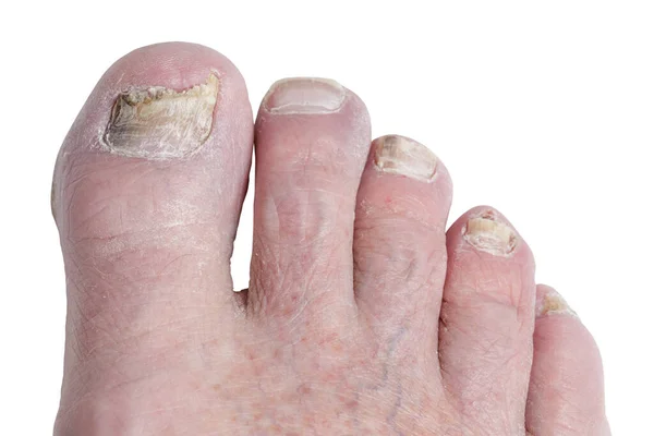 一只年迈的雄性脚因脚趾甲真菌或运动员的脚在白色背景下被隔离而遭受严重感染时的亲密接触 — 图库照片