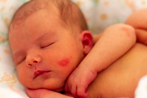 Adorabile Neonato Che Dorme Sereno Con Segno Ingrasso Sul Viso — Foto Stock