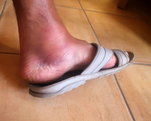 Broken ankle,foot man — Stock Photo, Image