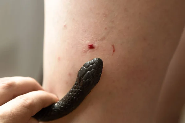 Venomous snake bite in man\'s leg, close-up.