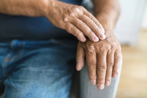 Sedef Hastalığından Muzdarip Yaşlı Bir Adam Elleri Kapalı — Stok fotoğraf