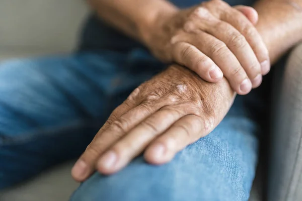 Älterer Mann Leidet Schuppenflechte Nahaufnahme Den Händen — Stockfoto