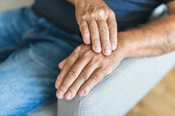 Oudere Man Die Lijdt Aan Psoriasis Close Handen — Stockfoto