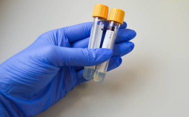Mavi eldivenli bir doktorun elinde sarı başlıklı iki test tüpü. Bir gezginin yardımıyla kan testinin teslim edilmesi. Damardan çıkan kan testi.