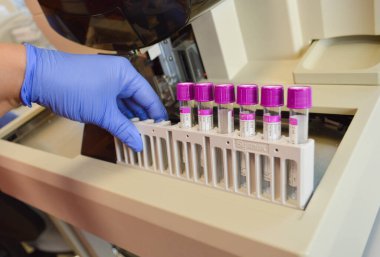 Mavi eldivenli bir doktor araştırma yapmak için test tüplerine mor başlık takıyor. Venöz kanla sağlık durumunun teşhisi.