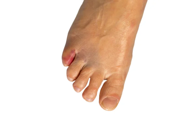 Bruised small toe of a woman against white background — Stock Photo, Image