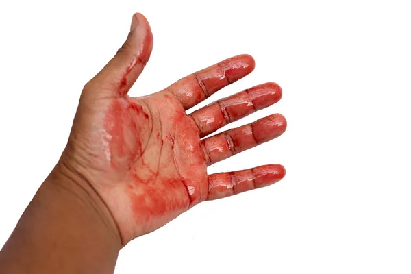 Hand Blood White Background — Stock Photo, Image