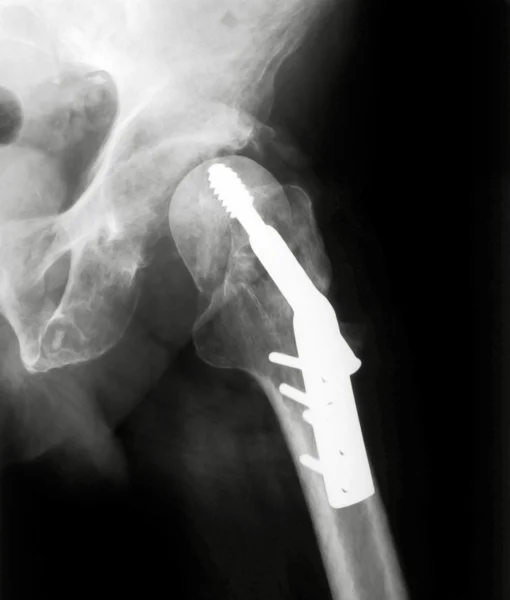 X-rayed Hip — Stock Photo, Image