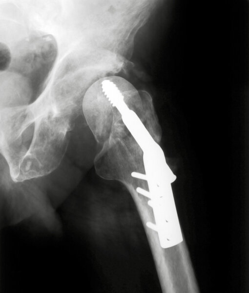 X-rayed Hip