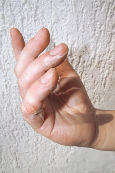 Έγκαυμα στα δάχτυλά — Φωτογραφία Αρχείου