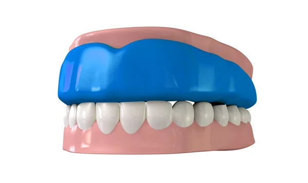 Gum Guard Fitted On Closed False Teeth — Stock Photo, Image