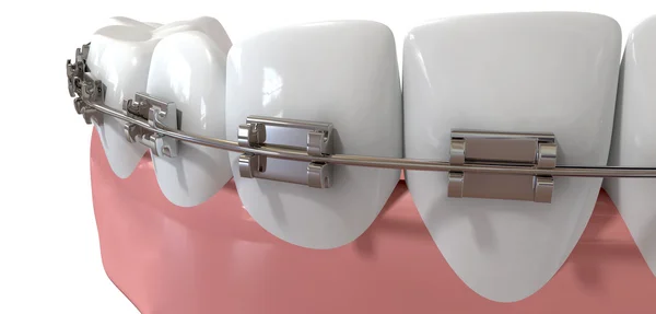 Primeros planos extremos de los dientes humanos con tirantes de metal — Foto de Stock