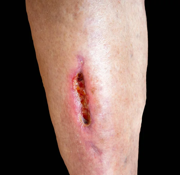 Deep Gaping Wound Lover Leg Medical Treatment Serious Injury Lack — Foto de Stock