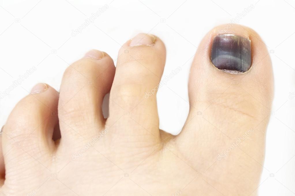 403 Black Toe Nail Fungus Royalty-Free Images, Stock Photos & Pictures |  Shutterstock