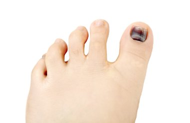 Subungual hematoma blue and black toe nail clipart
