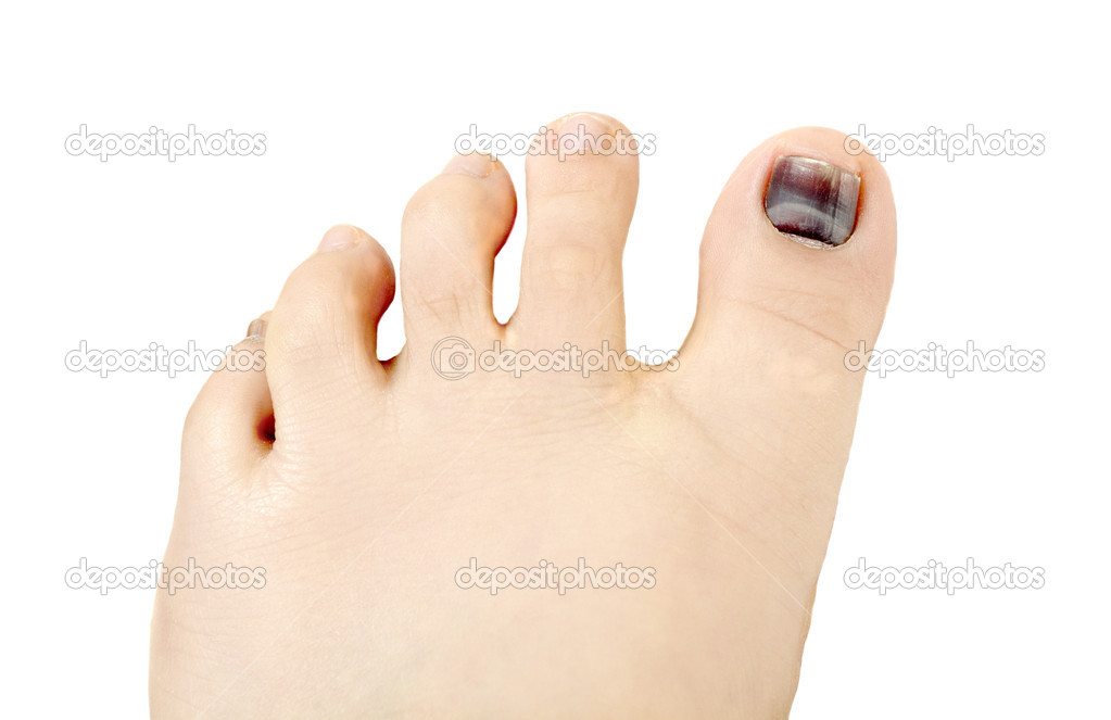 Subungual hematoma blue and black toe nail