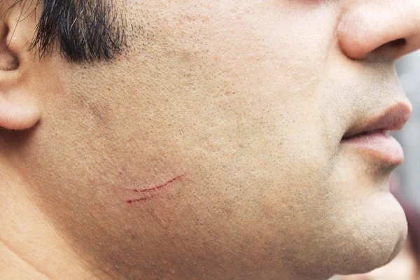 Ein Schnitt auf die männliche Wange mit Blut — Stockfoto