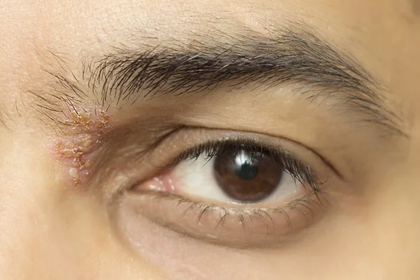 Герпетическая болезнь глаз - герпес Зостер офтальмикус Лицензионные Стоковые Изображения