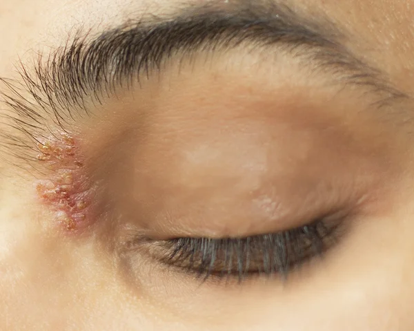 Doença ocular herpética - herpes zoster oftálmico Imagem De Stock