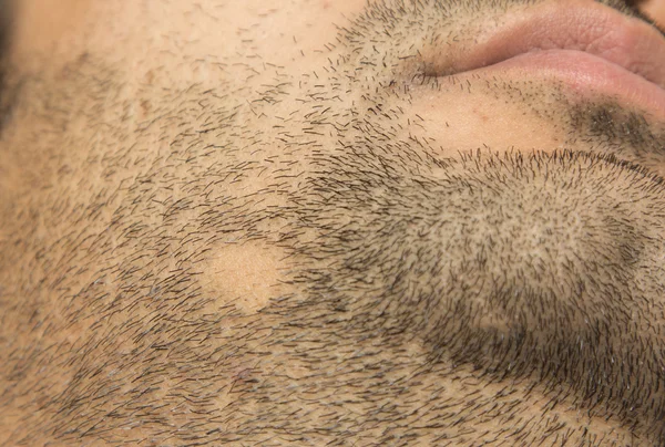 Alopecia Areata hair loss on cheek beard in a patch — Stock Photo, Image