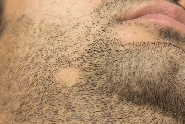 Alopecia Areata выпадение волос на щеке бороду в патч Стоковая Картинка